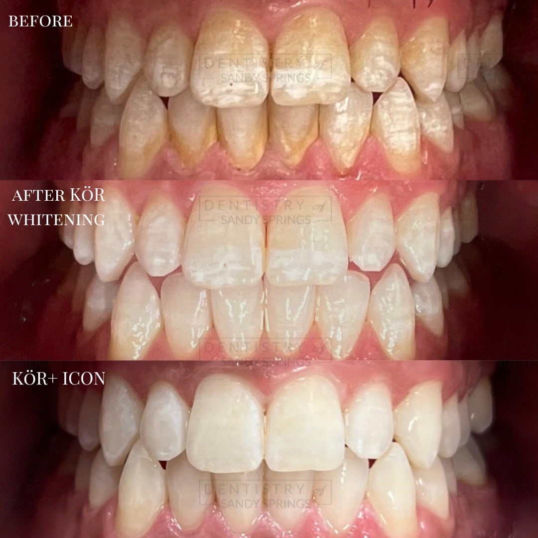 kor-whitening-before-and-after summerville sc